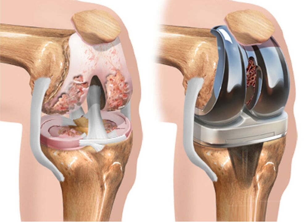 до і після ендопротезування колінного суглоба при артрозі