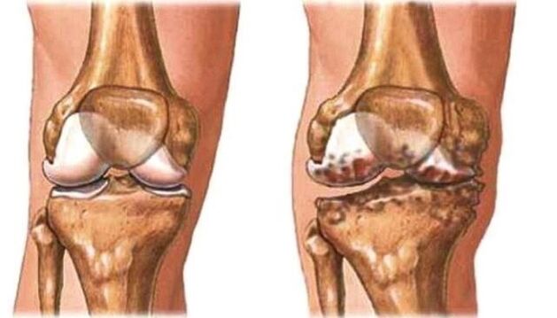 здорове коліно і артроз колінного суглоба