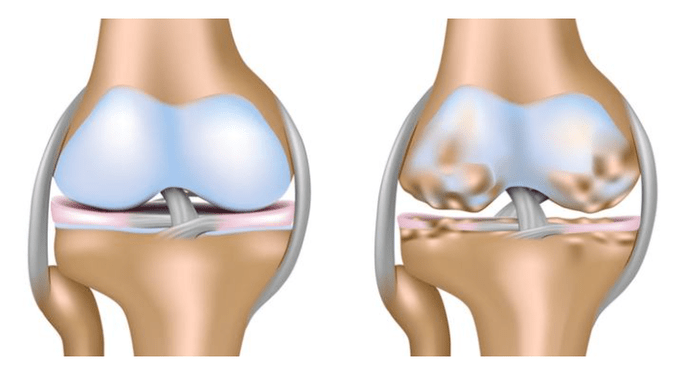 здоровий хрящ та поразка колінного суглоба при артрозі