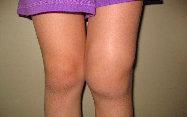 опухлий колінний суглоб при артрозі