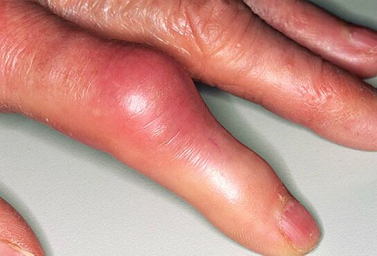 Подагру супроводжує різкий біль у пальцях рук та набряклість суглобів
