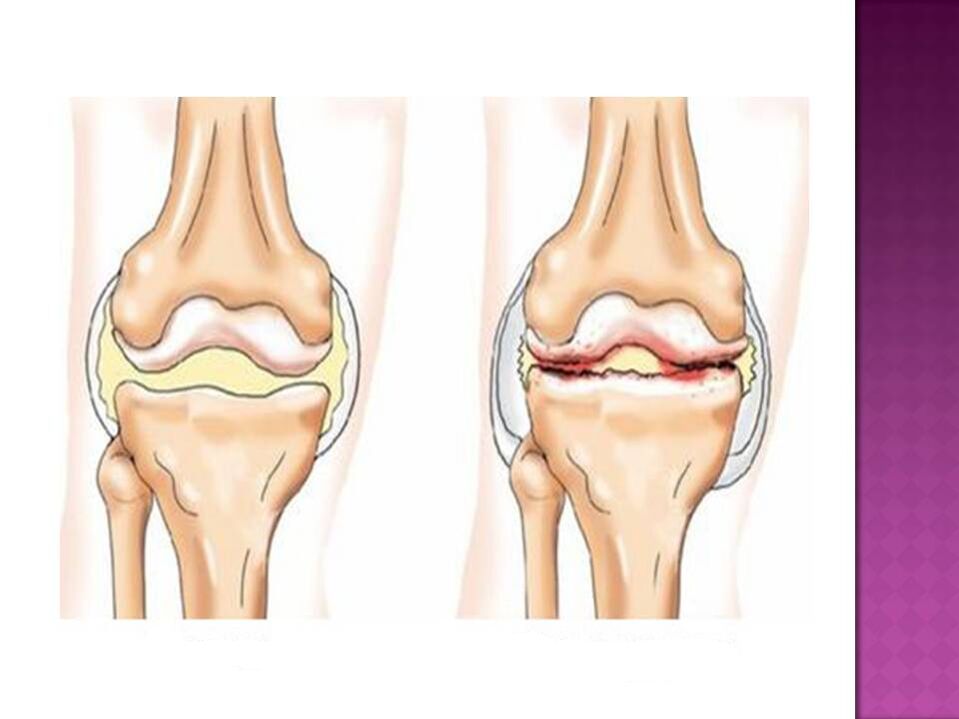 Суглоб у нормі (ліворуч) та уражений остеоартрозом (праворуч)