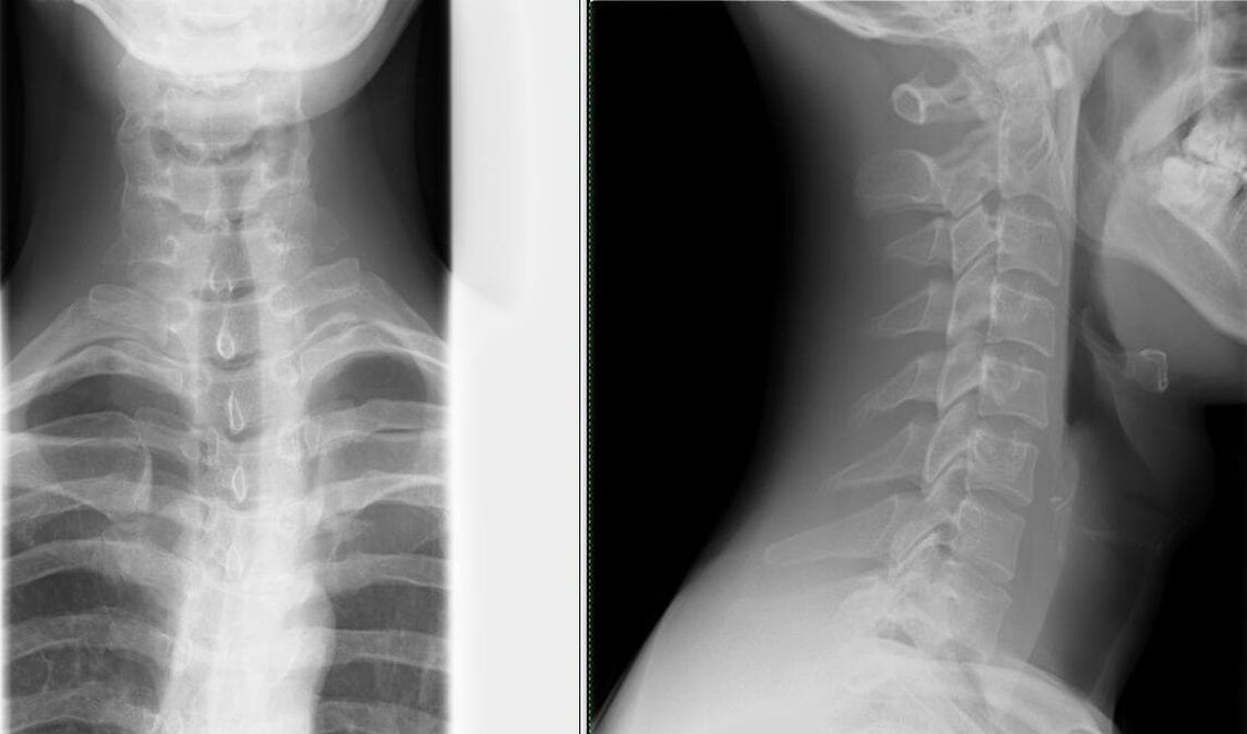 Рентгенограма хребта – простий та результативний метод діагностики остеохондрозу
